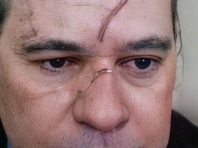 Dias Toffoli surge com hematomas no rosto em sessão do STF