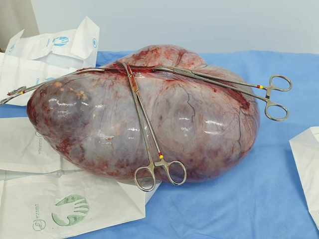 Tumor de 6.445kg, supostamente contendo cabelos e dentes, foi retirado de uma paciente em Soledade